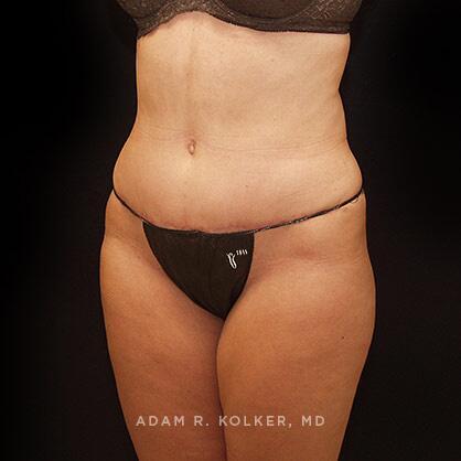 Tummy Tuck After Image Patient 44 Oblique View