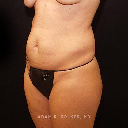 Tummy Tuck Before Image Patient 45 Oblique View