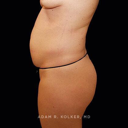 Tummy Tuck Before Image Patient 47 Side View