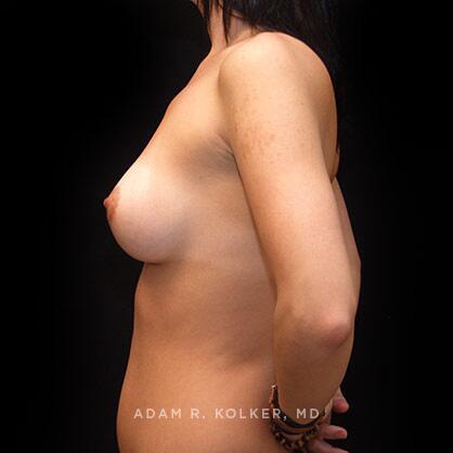 Breast Asymmetry After Image Patient 01 Side View