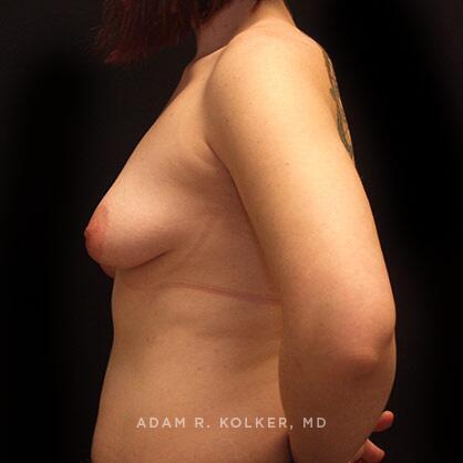 Breast Asymmetry Before Image Patient 02 Side View
