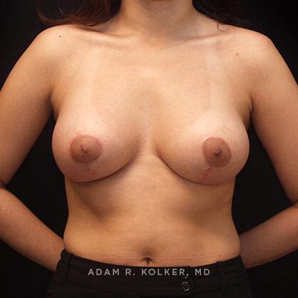 Breast Asymmetry After Image Patient 05 Front View