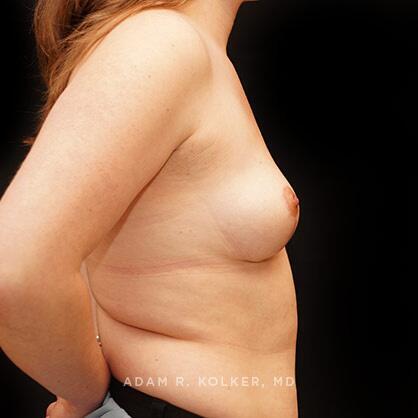 Breast Asymmetry After Image Patient 06 Side View