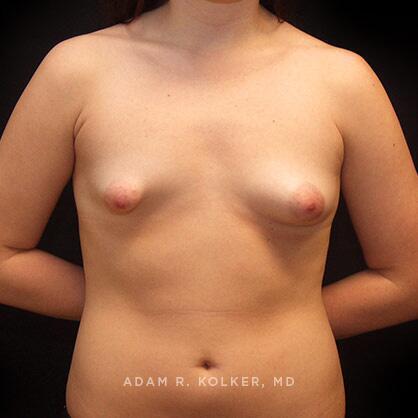 Breast Asymmetry Before Image Patient 07 Front View