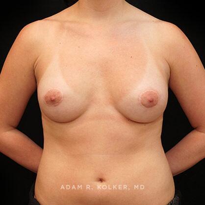 Breast Asymmetry After Image Patient 07 Front View