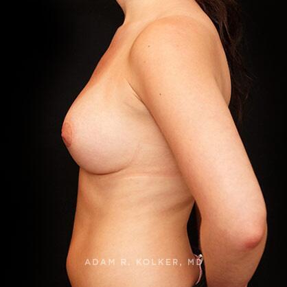 Breast Asymmetry After Image Patient 07 Side View