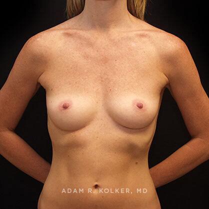 Breast Augmentation Before Image Patient 02 Front View