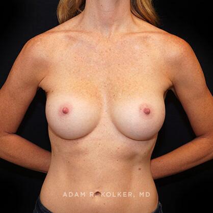 Breast Augmentation After Image Patient 02 Front View