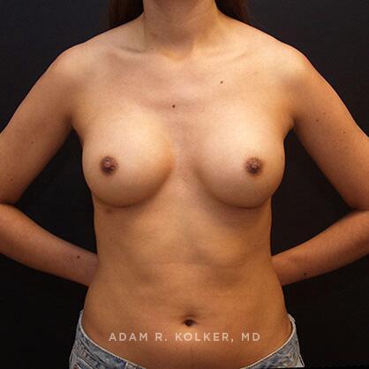 Breast Augmentation After Image Patient 03 Front View