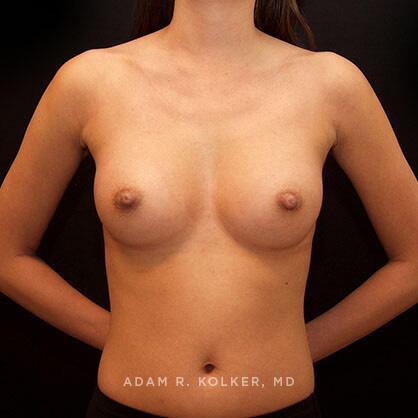 Breast Augmentation After Image Patient 04 Front View