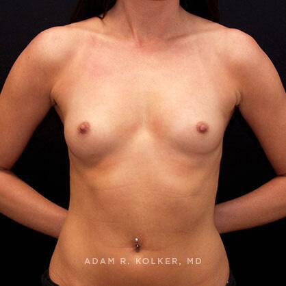 Breast Augmentation Before Image Patient 05 Front View