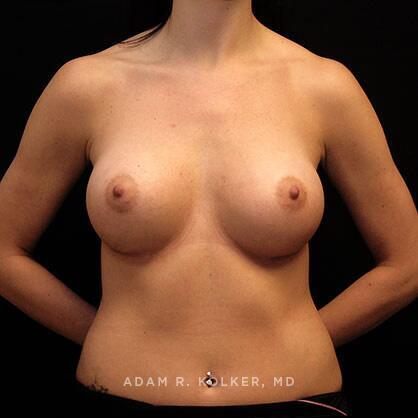 Breast Augmentation After Image Patient 06 Front View