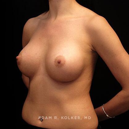 Breast Augmentation After Image Patient 06 Oblique View