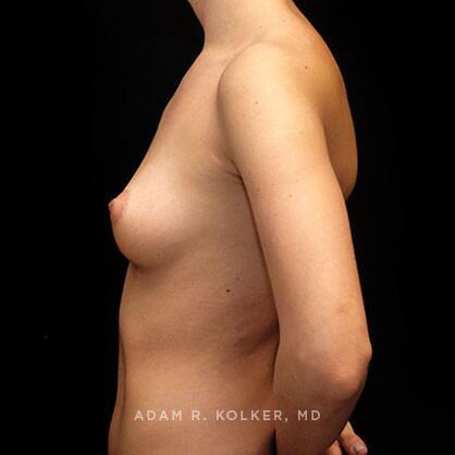 Breast Augmentation Before Image Patient 06 Side View