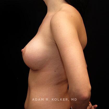 Breast Augmentation After Image Patient 06 Side View