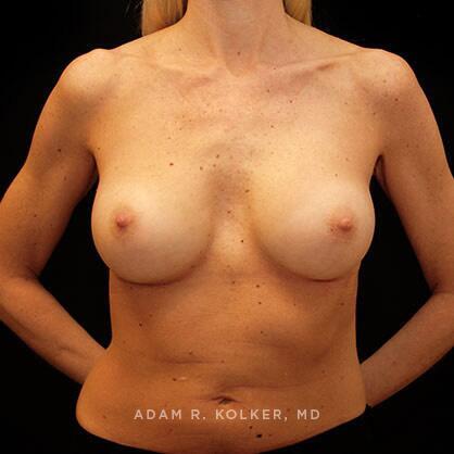 Breast Augmentation After Image Patient 07 Front View