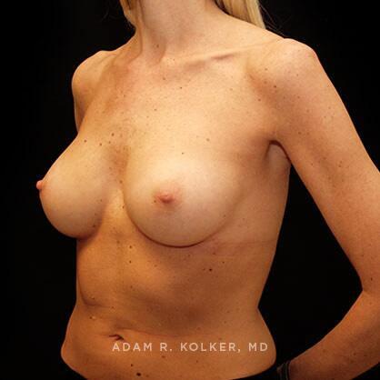 Breast Augmentation After Image Patient 07 Oblique View
