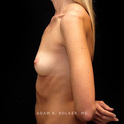 Breast Augmentation Before Image Patient 07 Side View