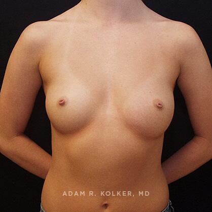 Breast Augmentation Before Image Patient 08 Front View