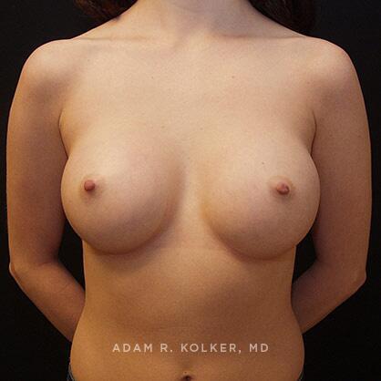 Breast Augmentation After Image Patient 08 Front View