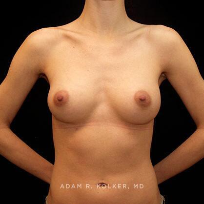 Breast Augmentation After Image Patient 09 Front View