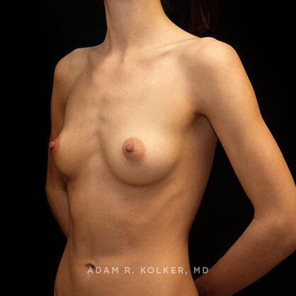 Breast Augmentation Before Image Patient 09 Oblique View