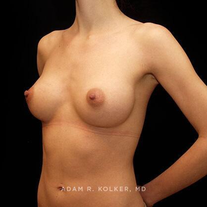 Breast Augmentation After Image Patient 09 Oblique View