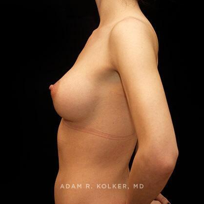 Breast Augmentation After Image Patient 09 Side View