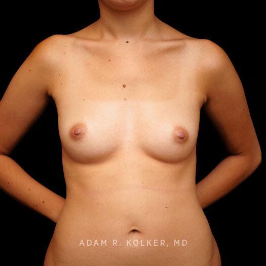 Breast Augmentation Before Image Patient 101 Front View