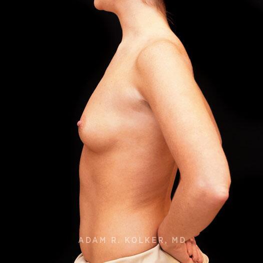 Breast Augmentation Before Image Patient 102 Side View