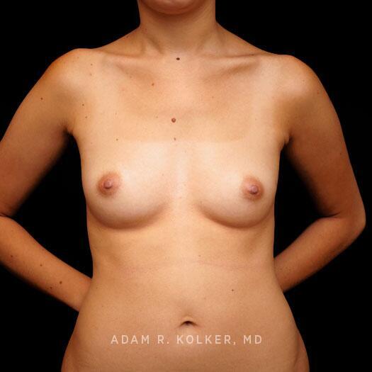 Breast Augmentation Before Image Patient 105 Front View