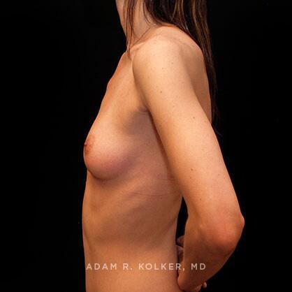 Breast Augmentation After Image Patient 11 Side View