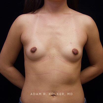 Breast Augmentation Before Image Patient 12 Front View