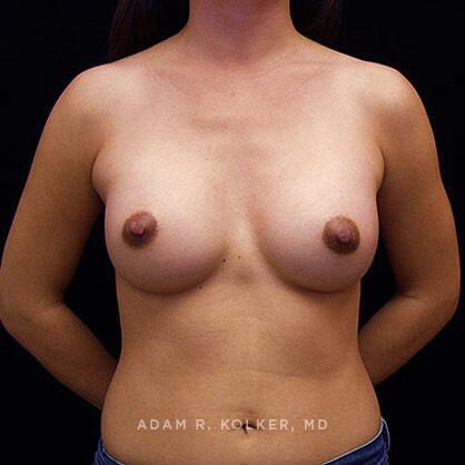 Breast Augmentation After Image Patient 12 Front View