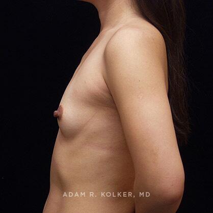 Breast Augmentation Before Image Patient 12 Side View