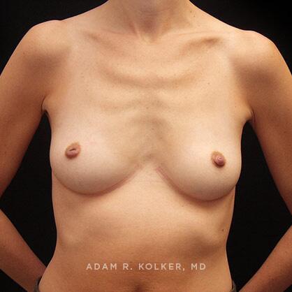Breast Augmentation Before Image Patient 13 Front View