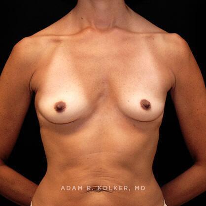 Breast Augmentation Before Image Patient 17 Front View