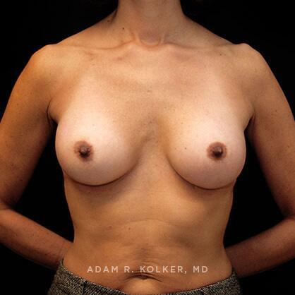 Breast Augmentation After Image Patient 17 Front View