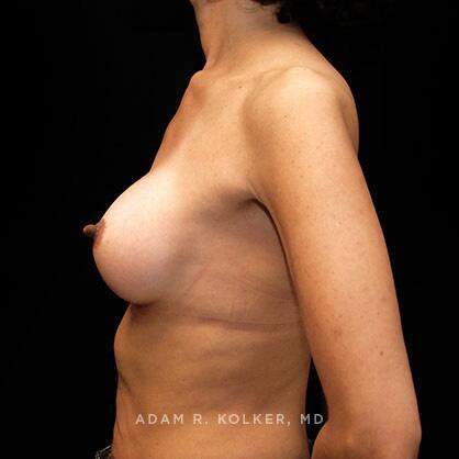 Breast Augmentation After Image Patient 17 Side View