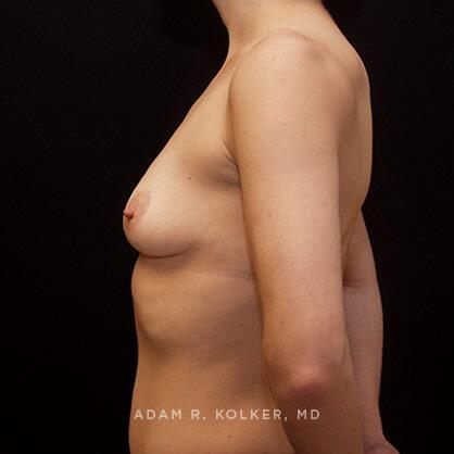 Breast Augmentation Before Image Patient 18 Side View