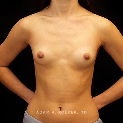 Breast Augmentation Before Image Patient 19 Front View