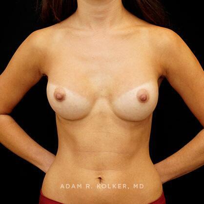 Breast Augmentation After Image Patient 19 Front View