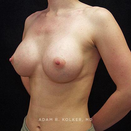 Breast Augmentation After Image Patient 20 Oblique View