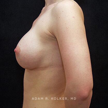 Breast Augmentation After Image Patient 20 Side View