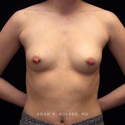 Breast Augmentation Before Image Patient 22 Front View
