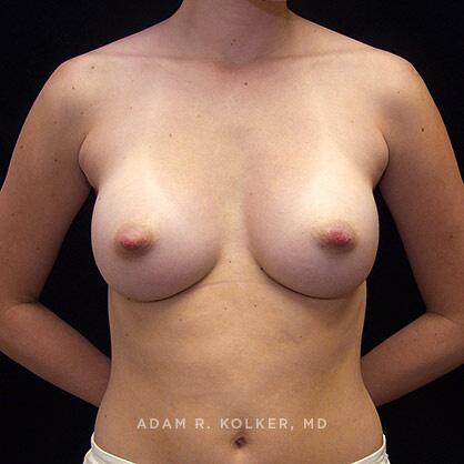 Breast Augmentation After Image Patient 22 Front View