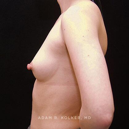 Breast Augmentation Before Image Patient 22 Side View