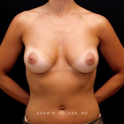 Breast Augmentation After Image Patient 24 Front View
