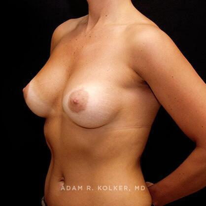 Breast Augmentation After Image Patient 24 Oblique View