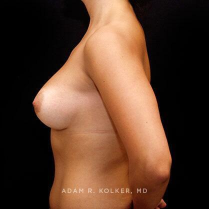 Breast Augmentation After Image Patient 24 Side View
